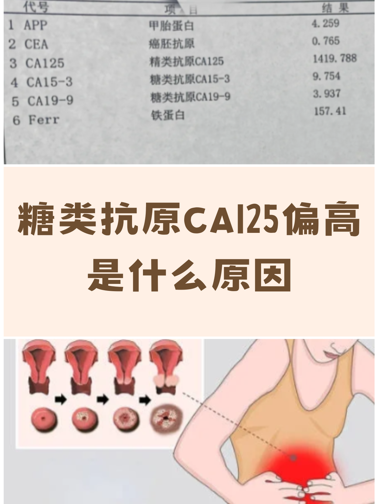 糖类抗原125高怎么办