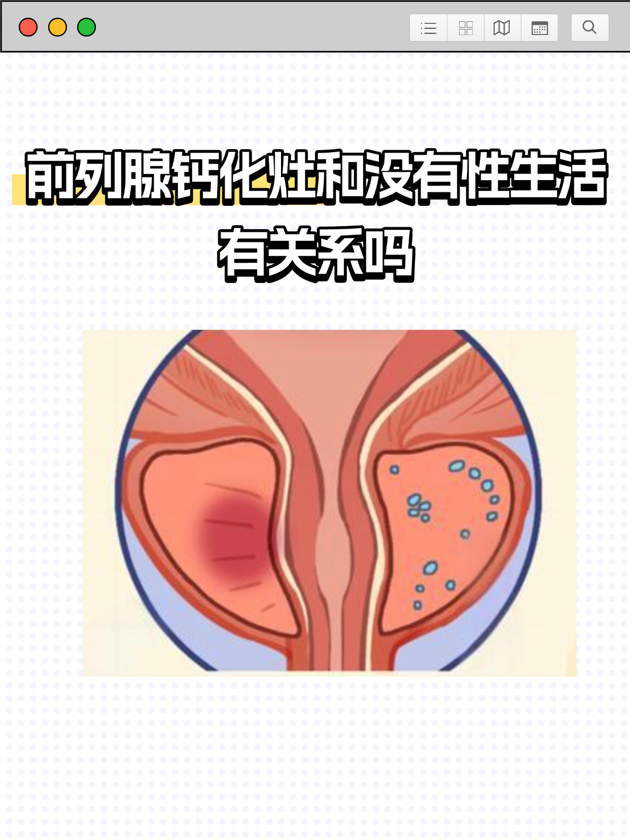 前列腺钙化灶影响生育吗