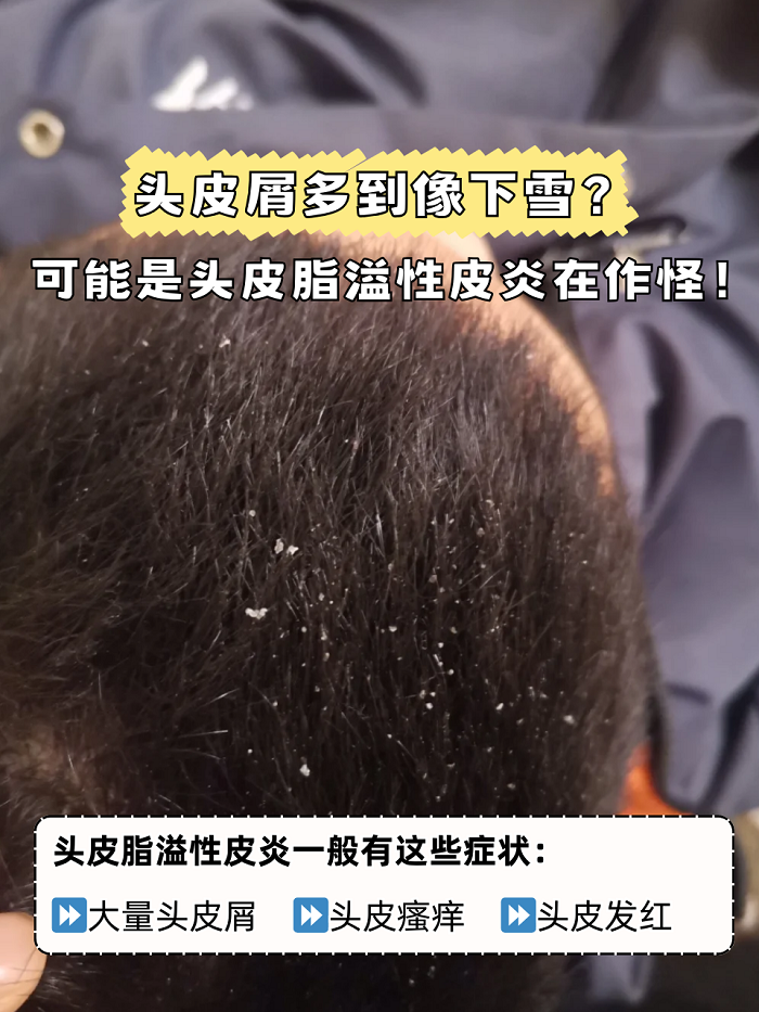 头部脂溢性皮炎可以根治吗
