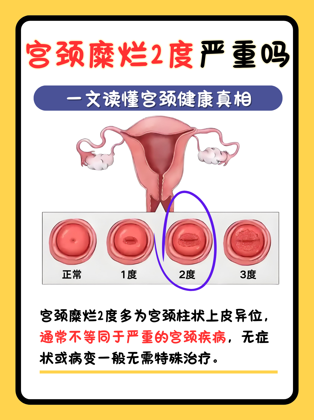 宫颈糜烂重度,怎么治疗