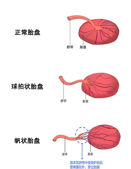 胎盘后壁是什么意思