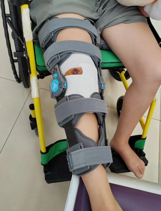 骨折70天一般能走路吗