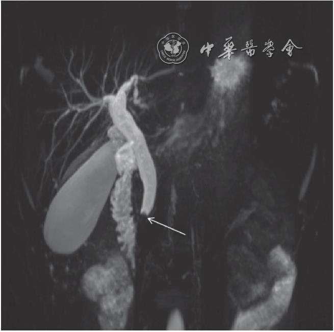 MRCP是一种什么检查