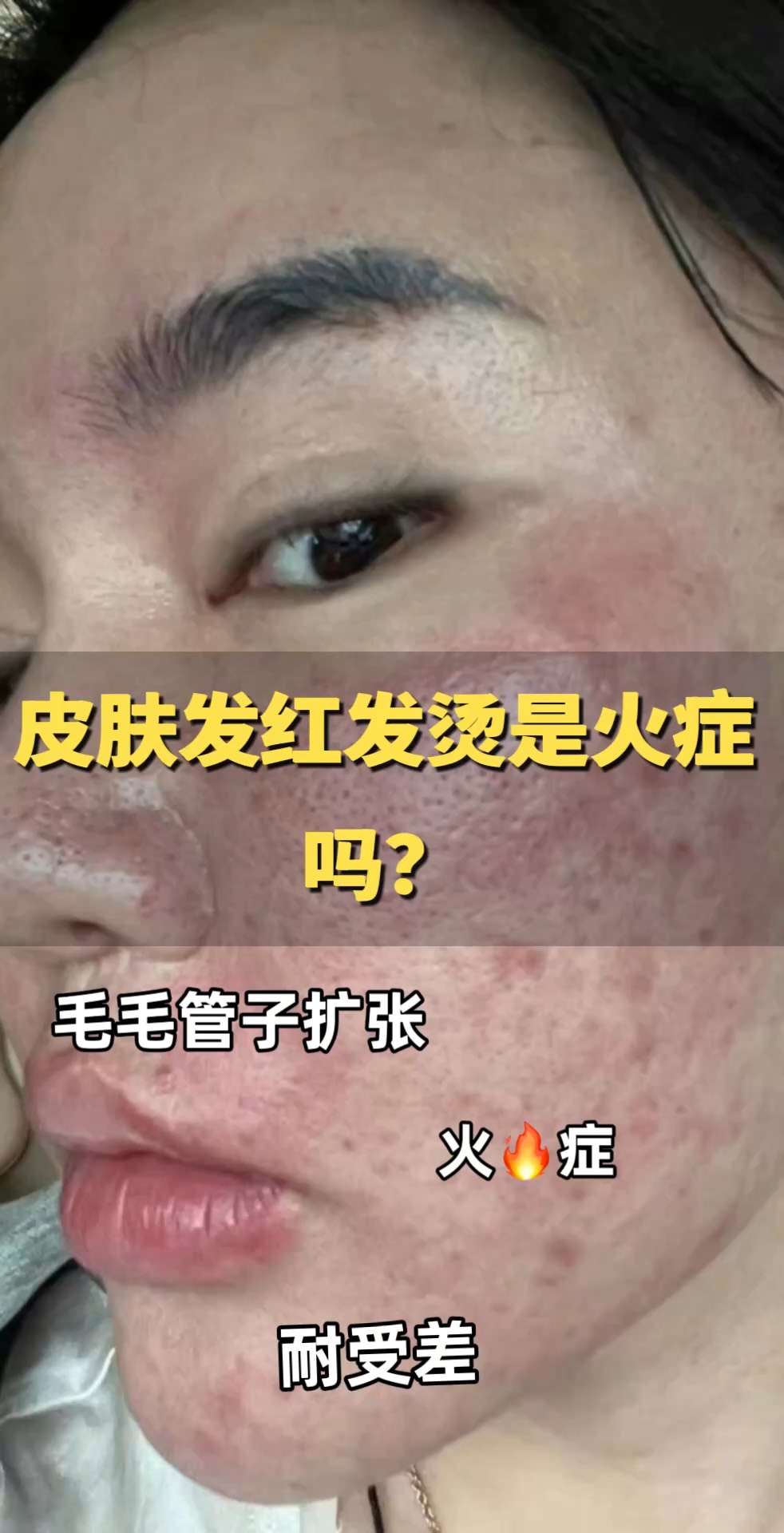 脸部发烫,但不发烧是怎么回事?