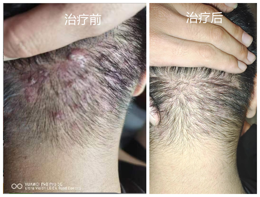 糠秕孢子菌毛囊炎治疗