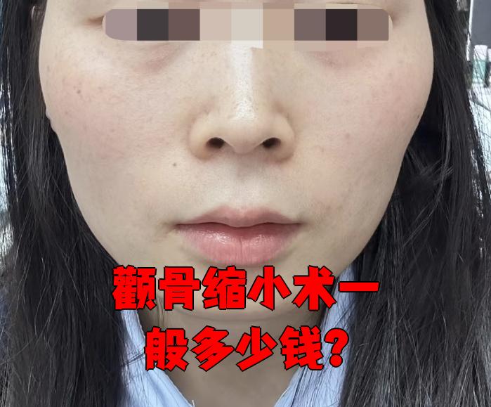 怎样使颧骨变小,不动手术.