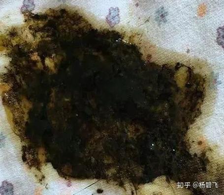 大便是黑色的怎么回事?