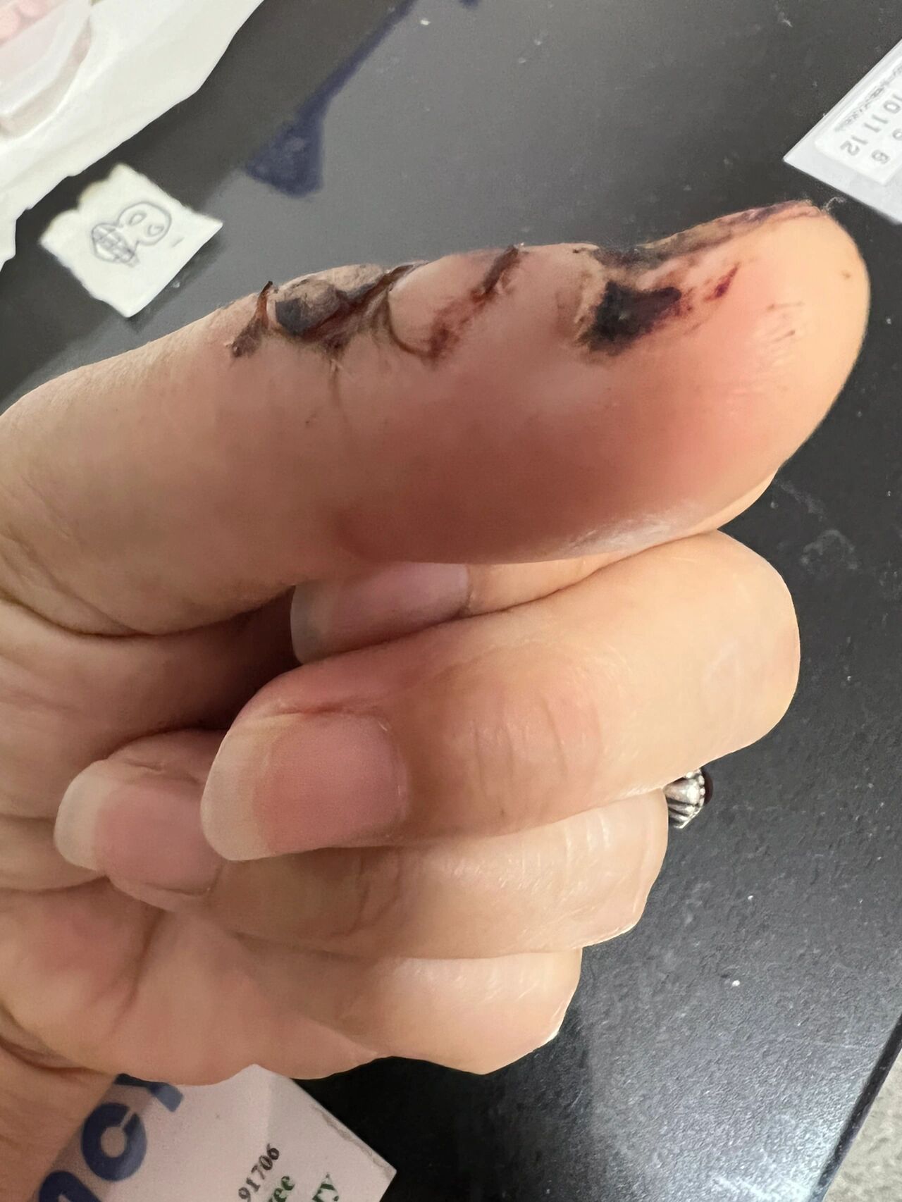 我的手缝针后拆线以后遗留了一个结痂组织
