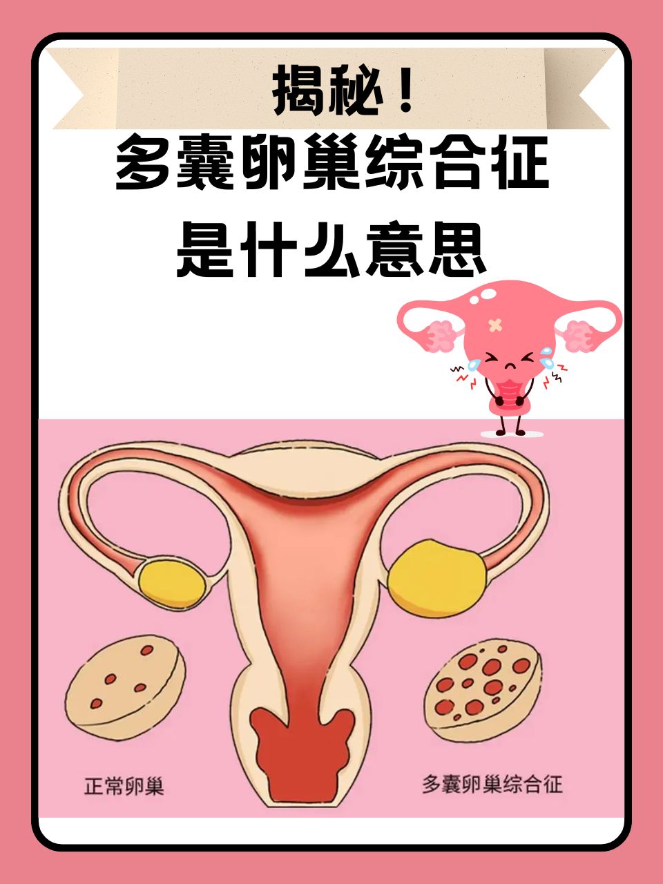 卵巢多囊样改变严重吗