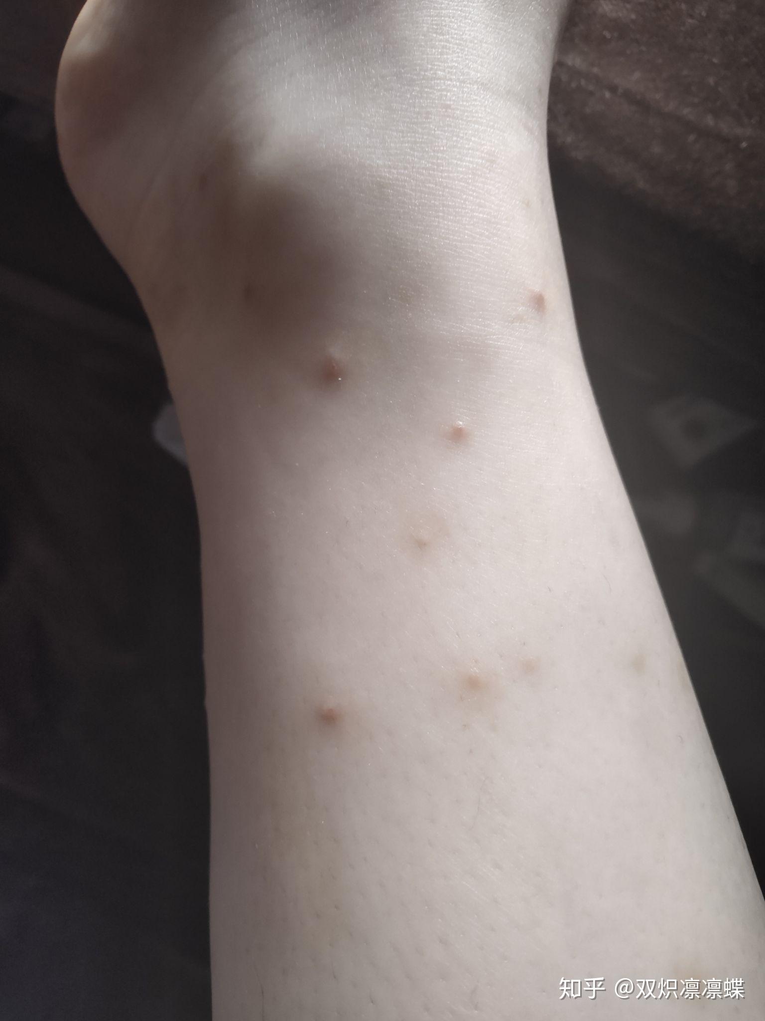 被跳蚤咬的症状