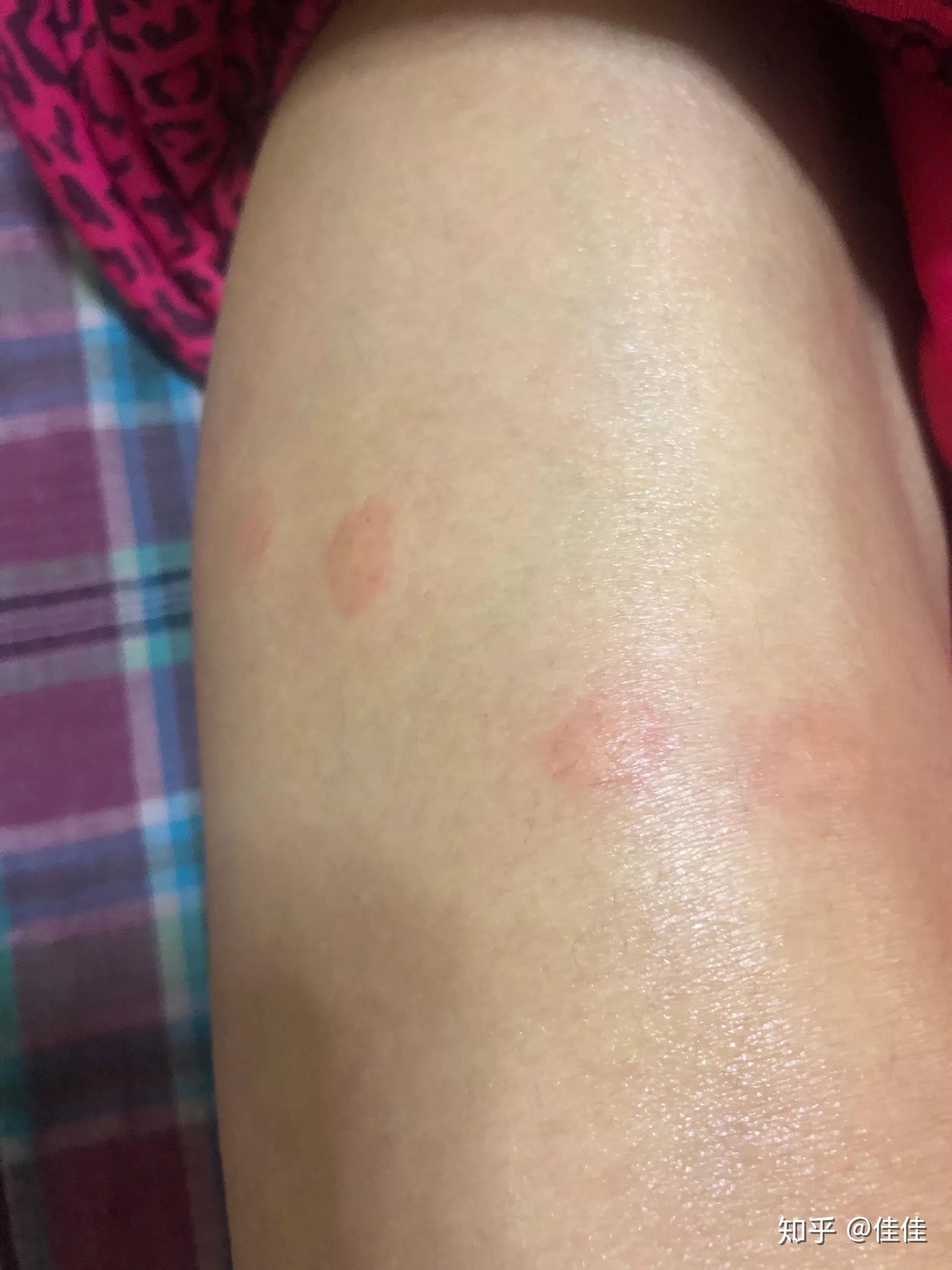 被跳蚤咬的症状