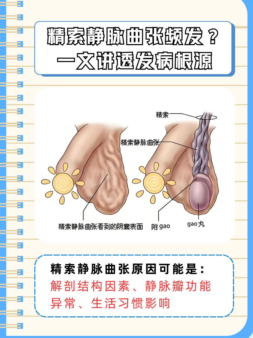精索静脉曲张的病因是什么