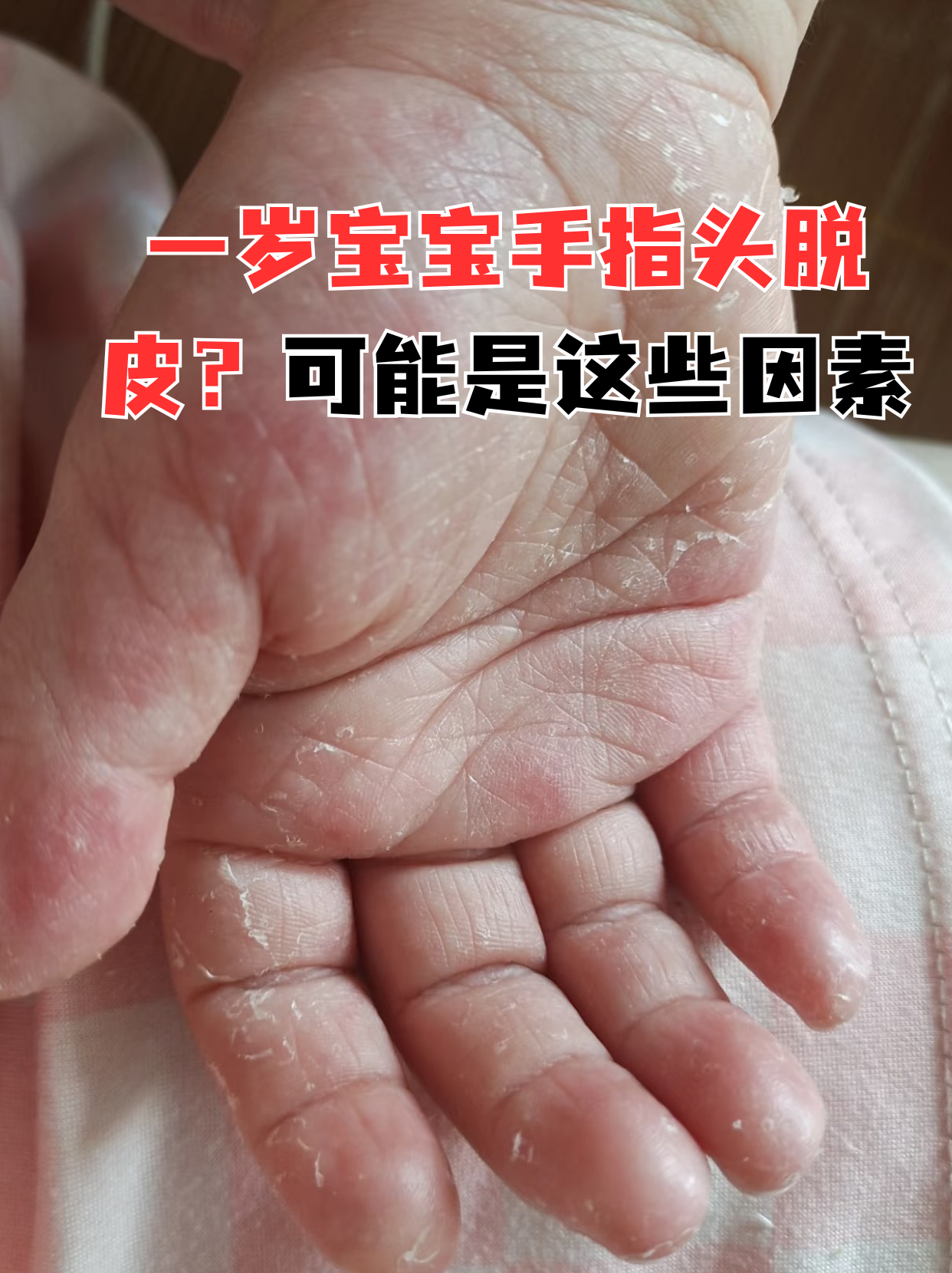 小孩手指脱皮缺什么