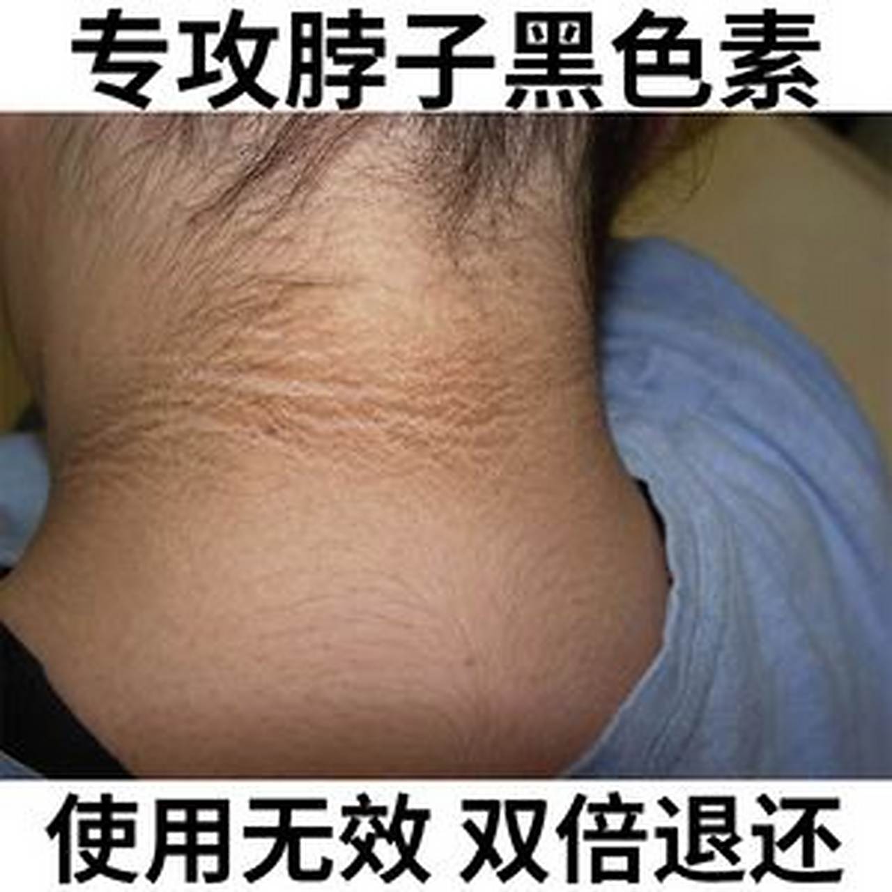 脖子黑怎么办