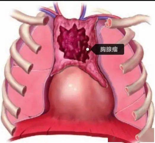 什么是胸腺瘤