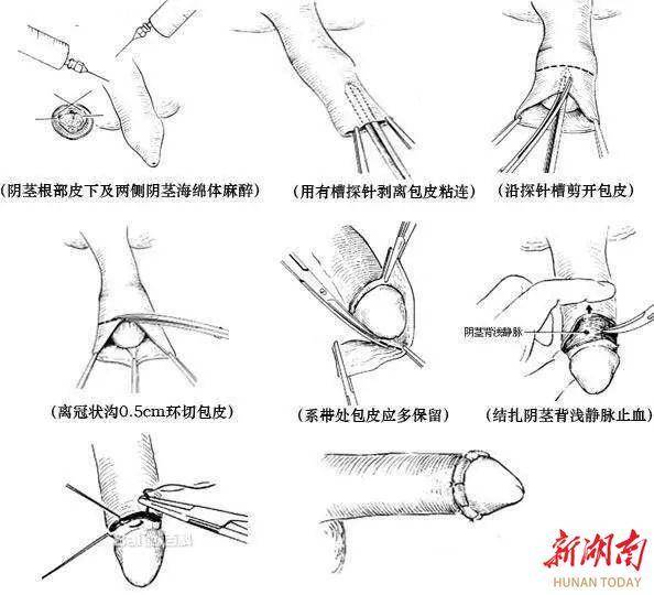 包皮手术10天左右伤口有一点裂开