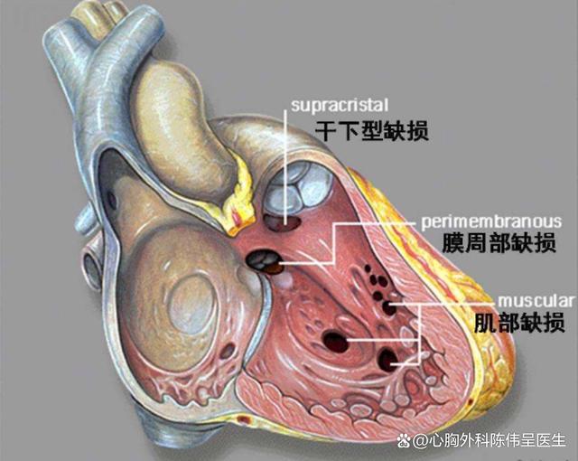 室间隔缺损手术费用多少现在