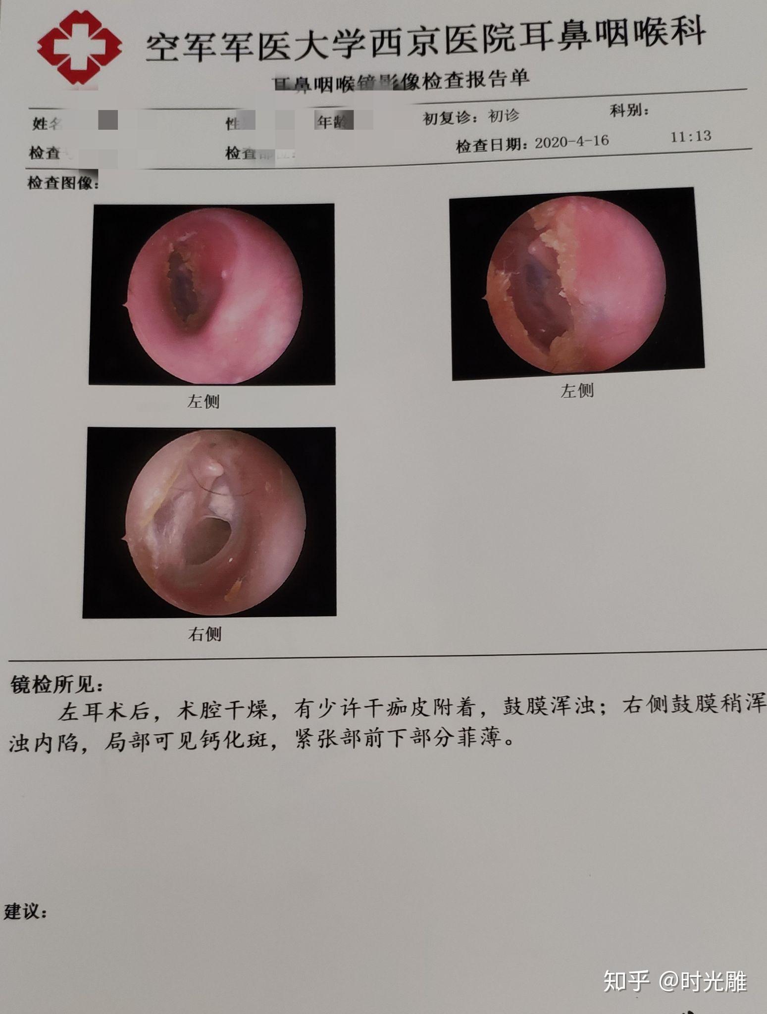 中耳炎手术后多久恢复