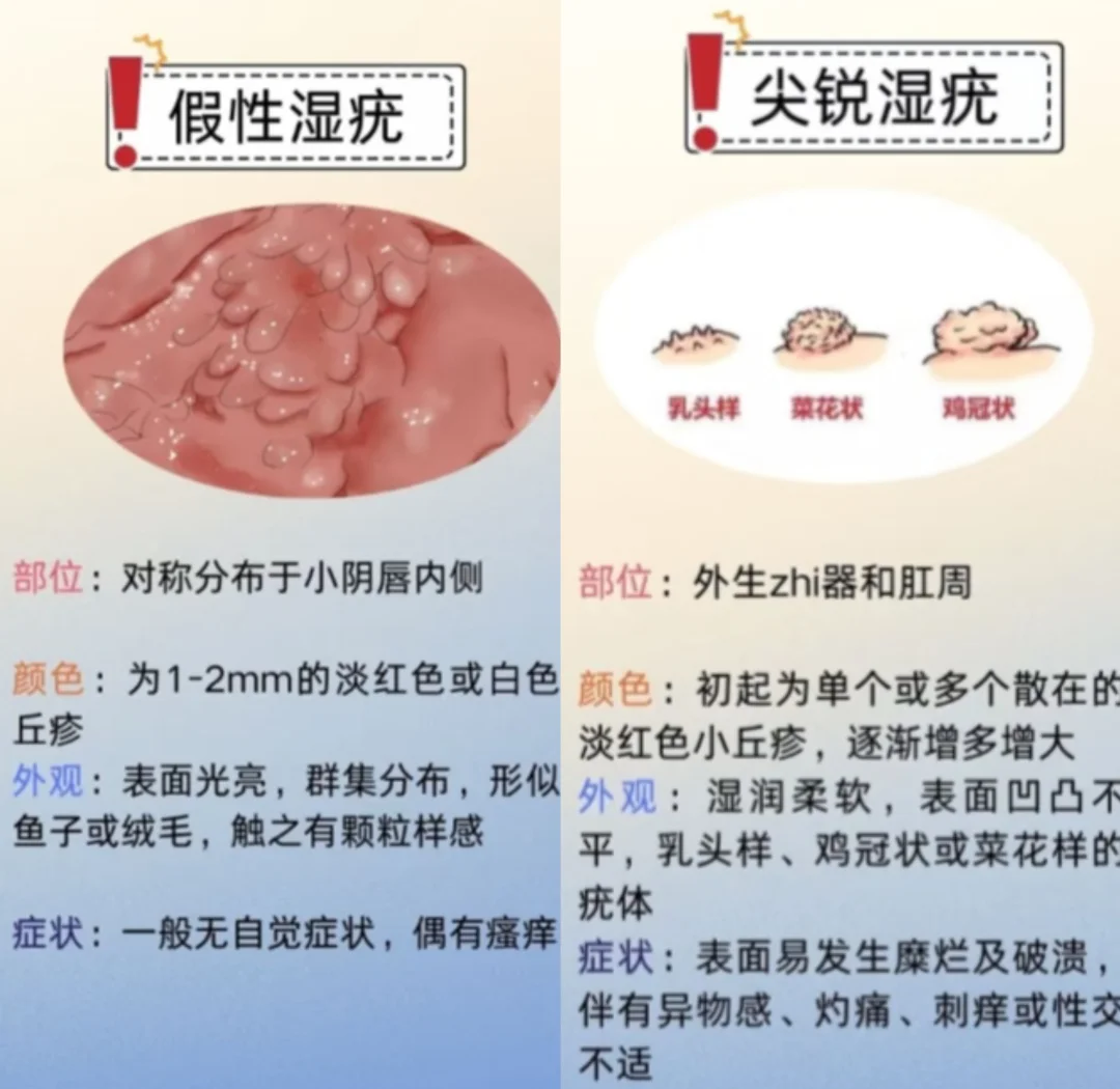 尖锐湿疣的醋酸白实验前后对比