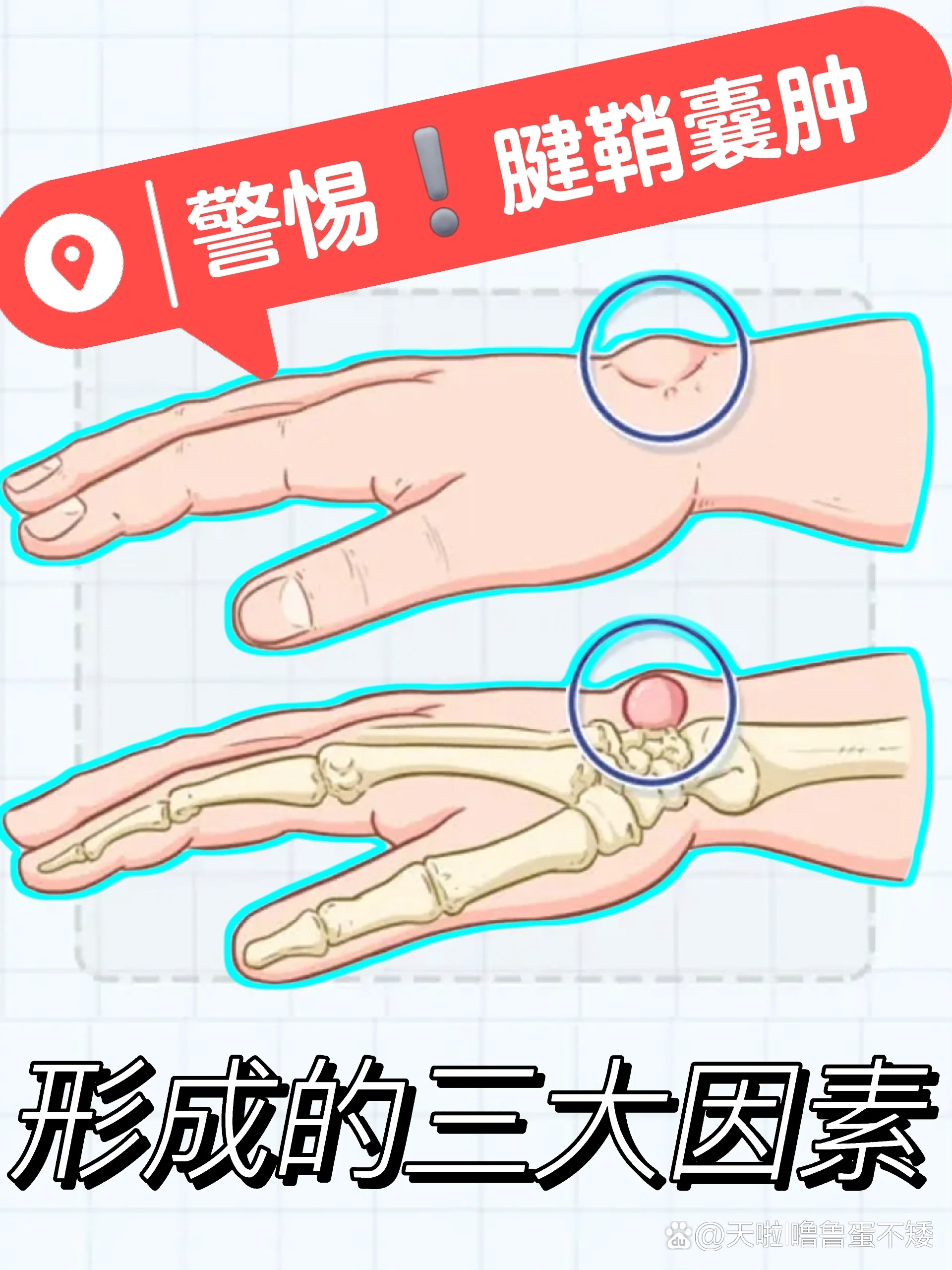 腱鞘囊肿挂什么科