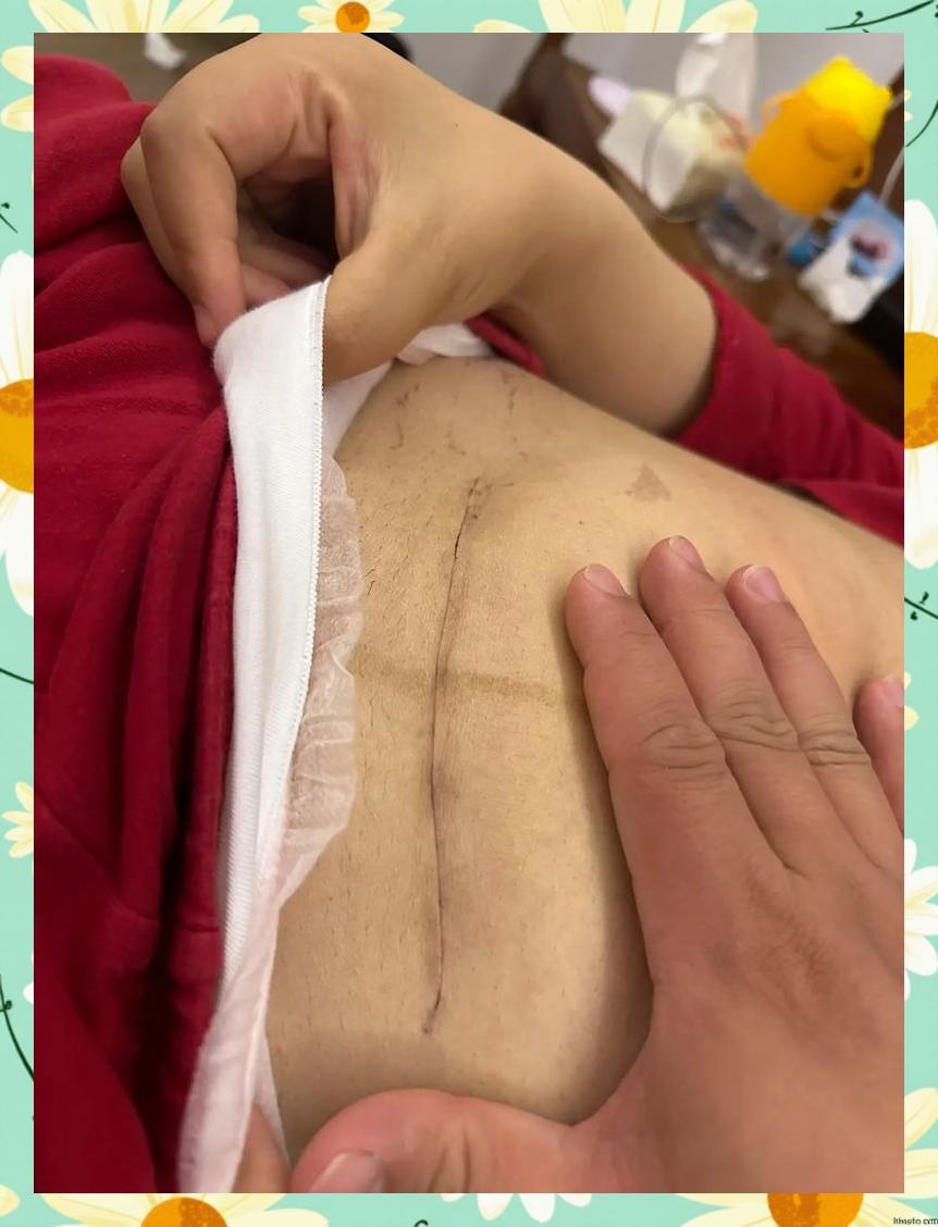 剖腹产手术