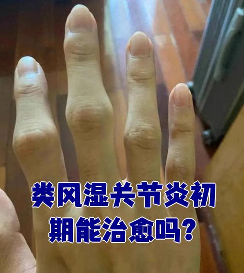 风湿病可以治愈吗