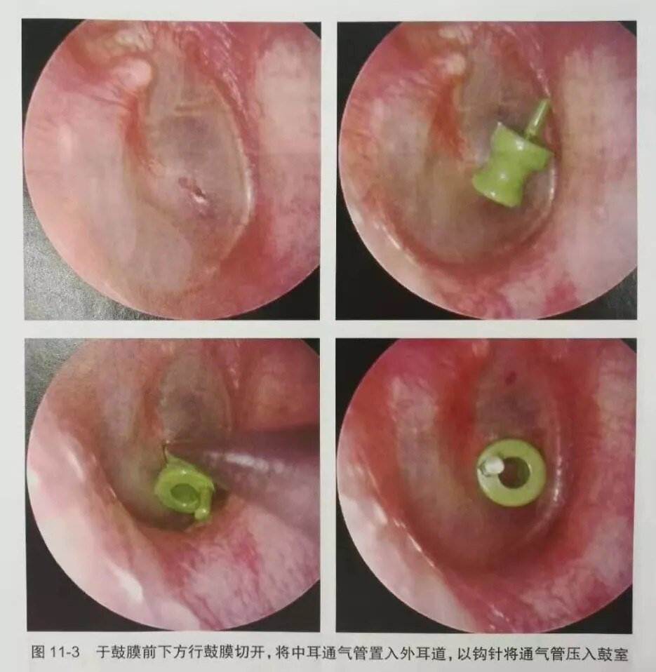 鼓膜内陷的症状