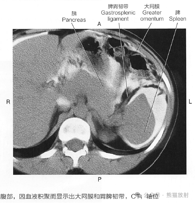 腹膜后纤维化是癌吗
