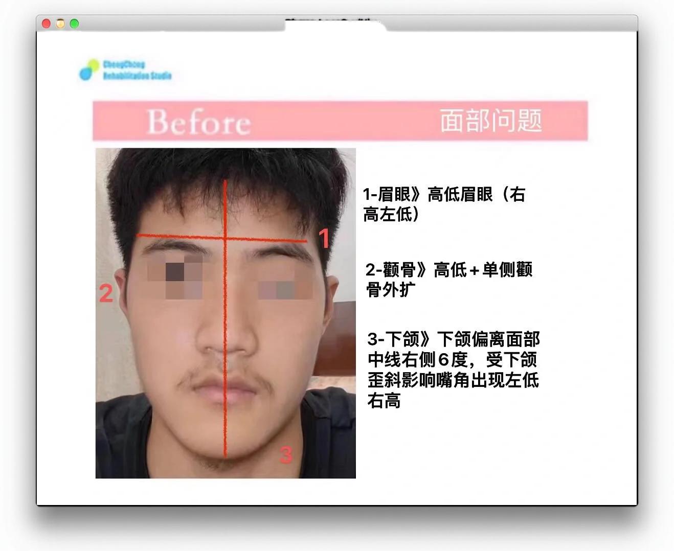 左右脸不一样大小怎么矫正