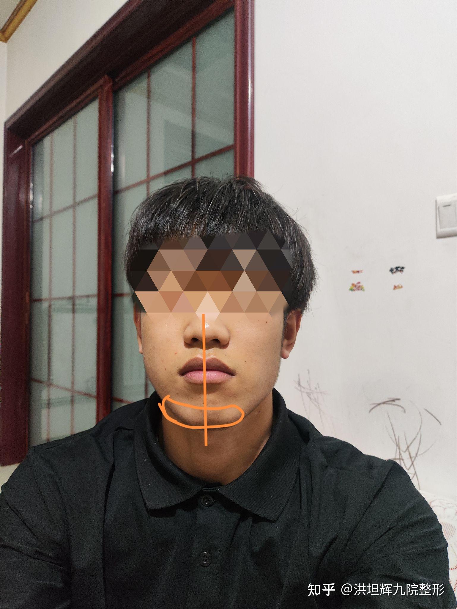 两边脸不对称,骨头也不对称