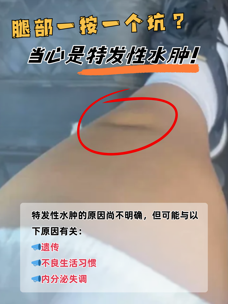腿浮肿是什么原因引起的