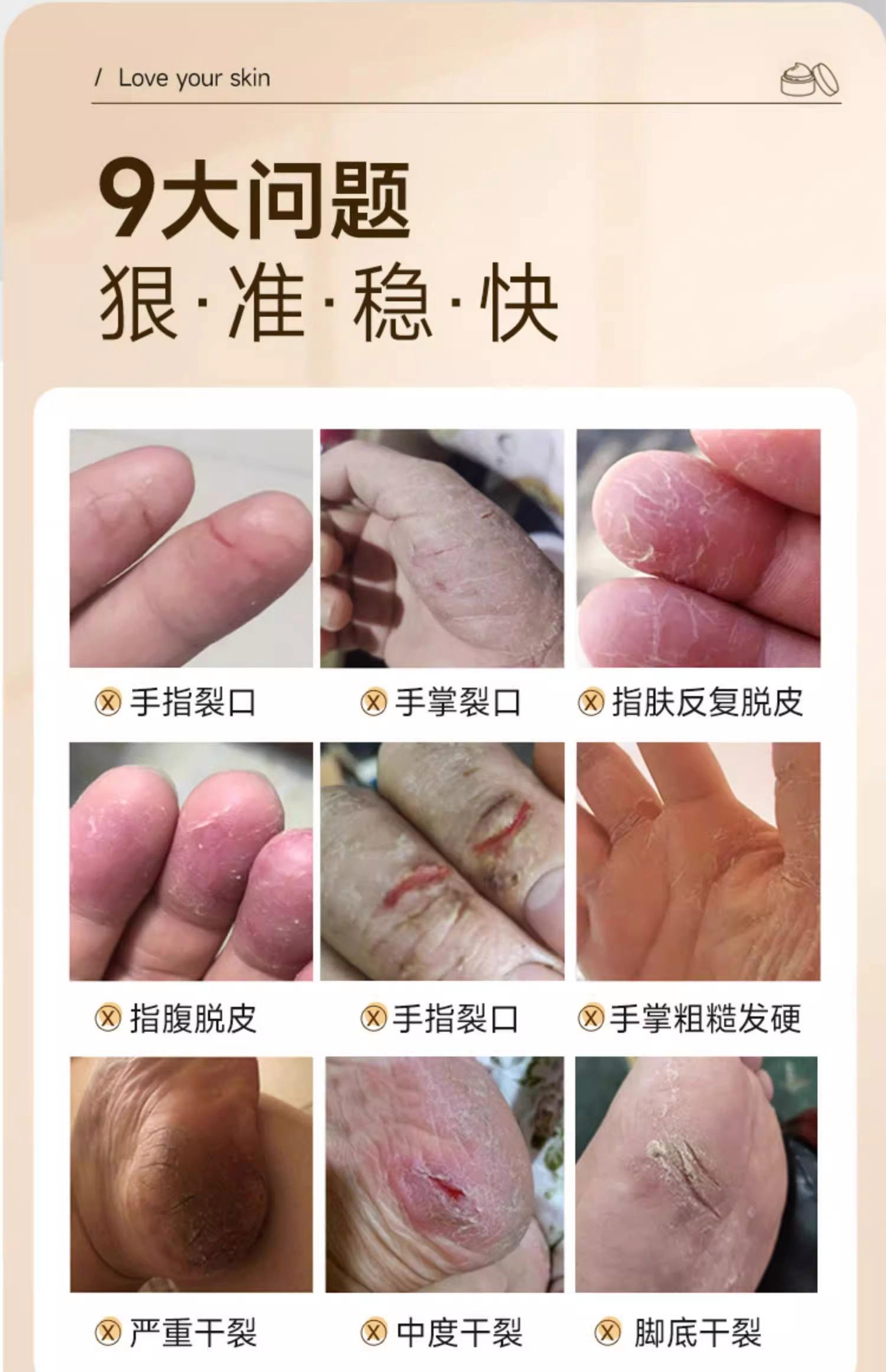手裂怎么治疗