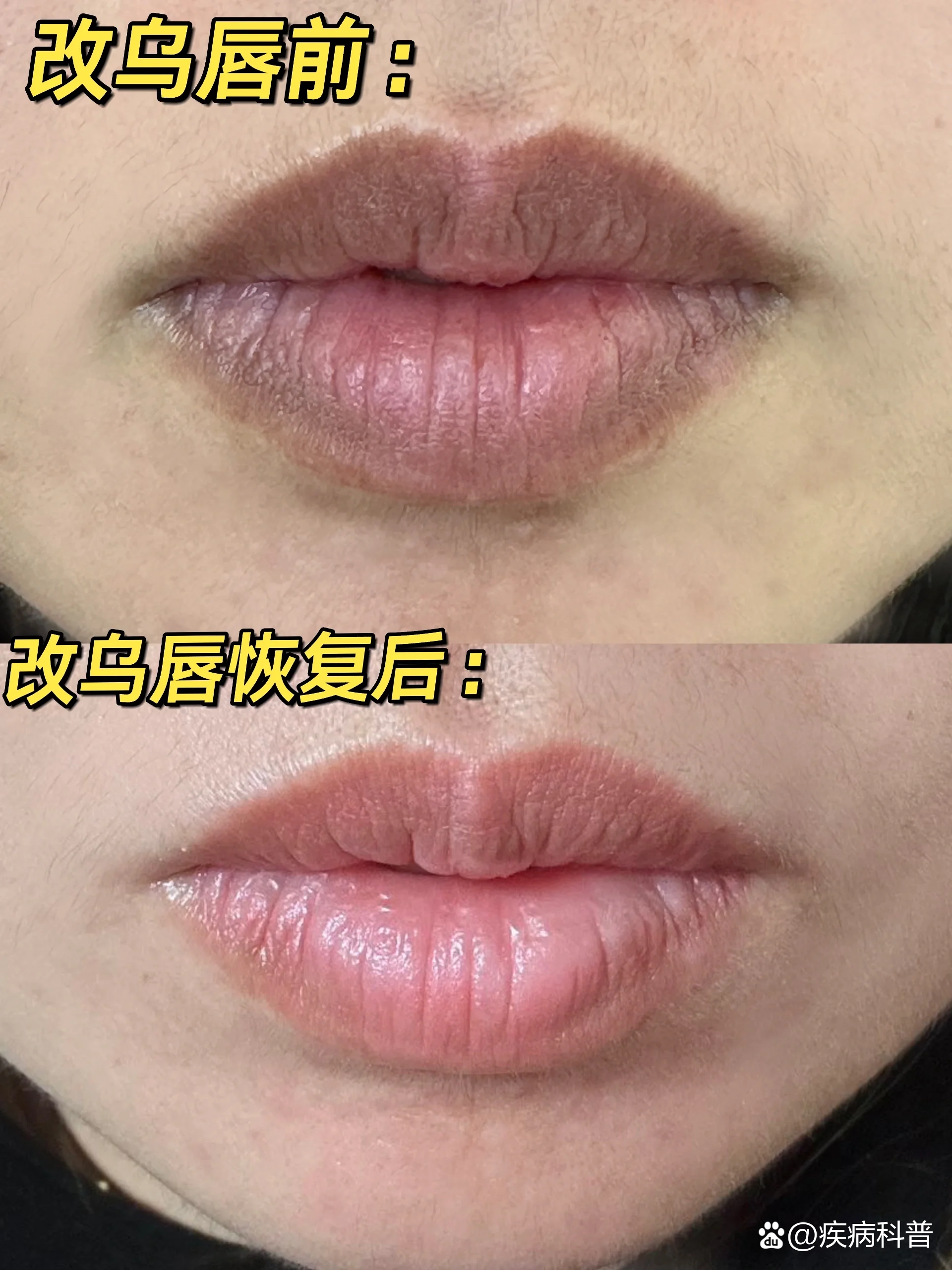 嘴唇边发黑是什么原因