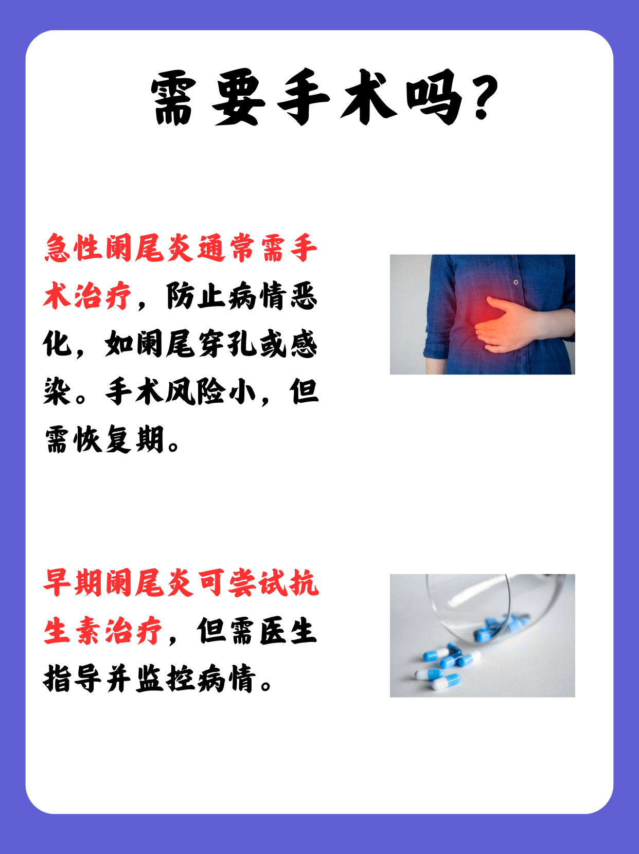 阑尾炎手术要住院吗