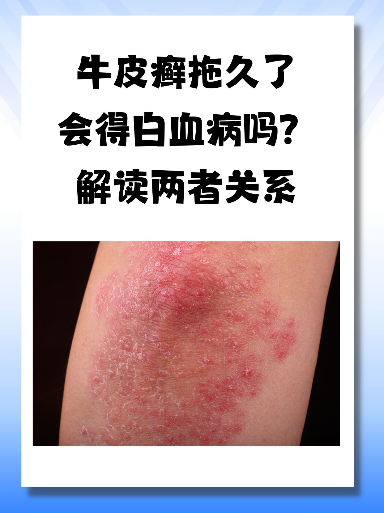银屑病传染吗可怕吗