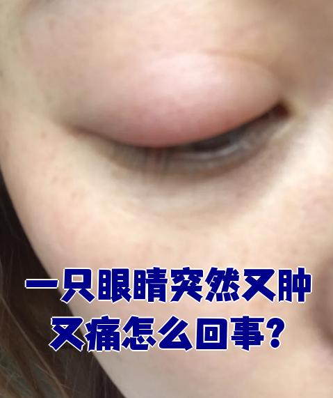眼皮肿是怎么回事?