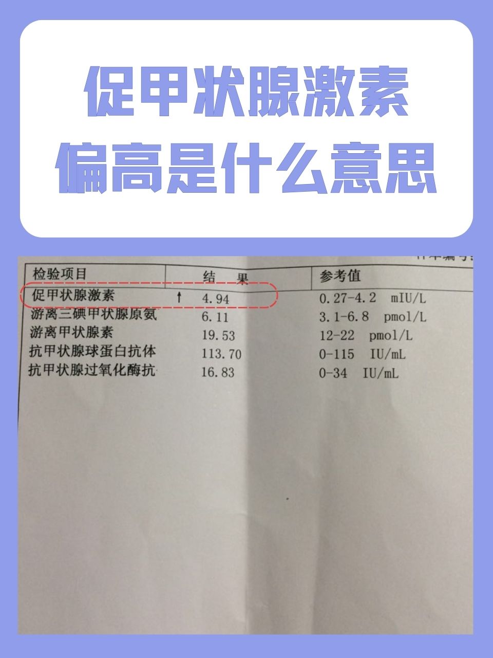 抗甲状腺球蛋白抗体高是怎么回事?