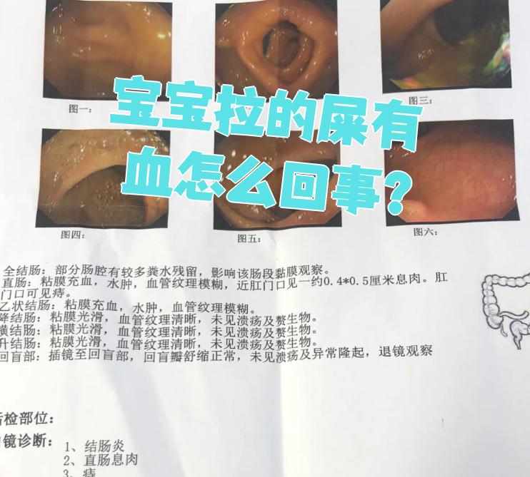 宝宝放屁带屎是怎么回事