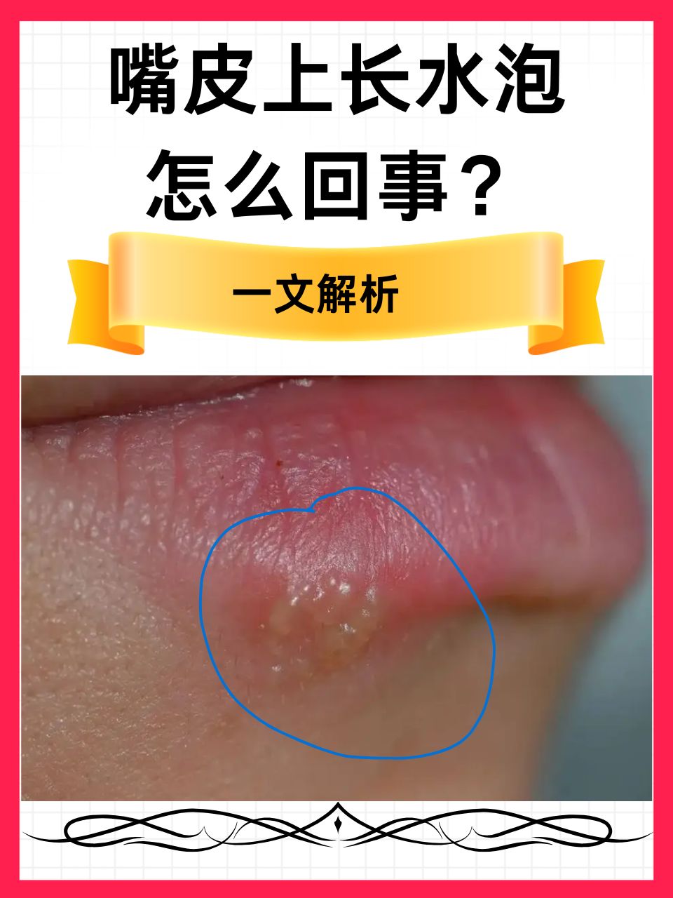 下嘴唇里面起了泡泡是什么