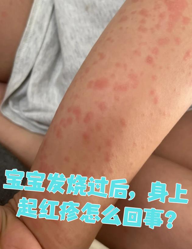 身上长红疹不疼不痒的是什么引起的