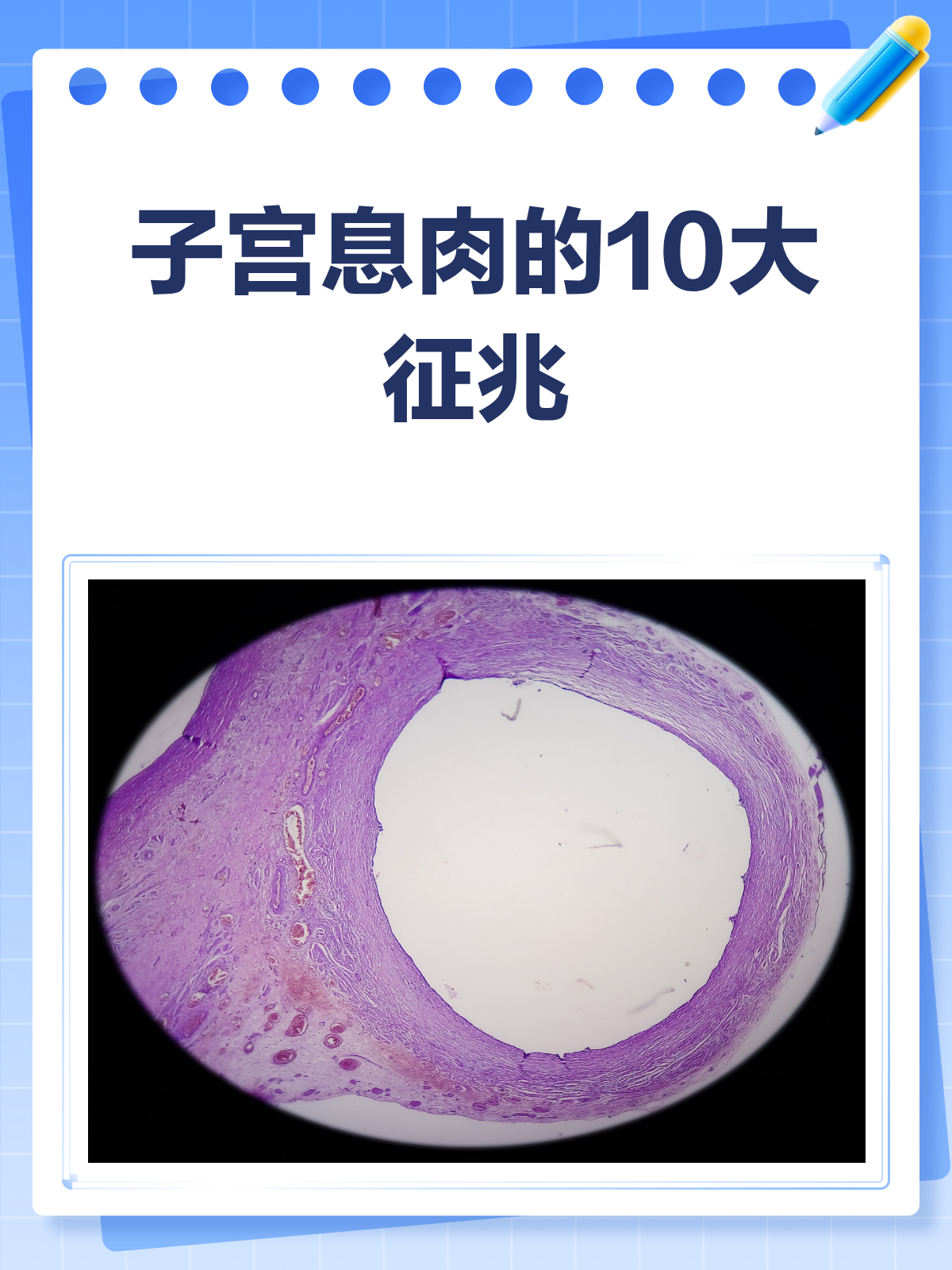 宫腔息肉的症状有哪些