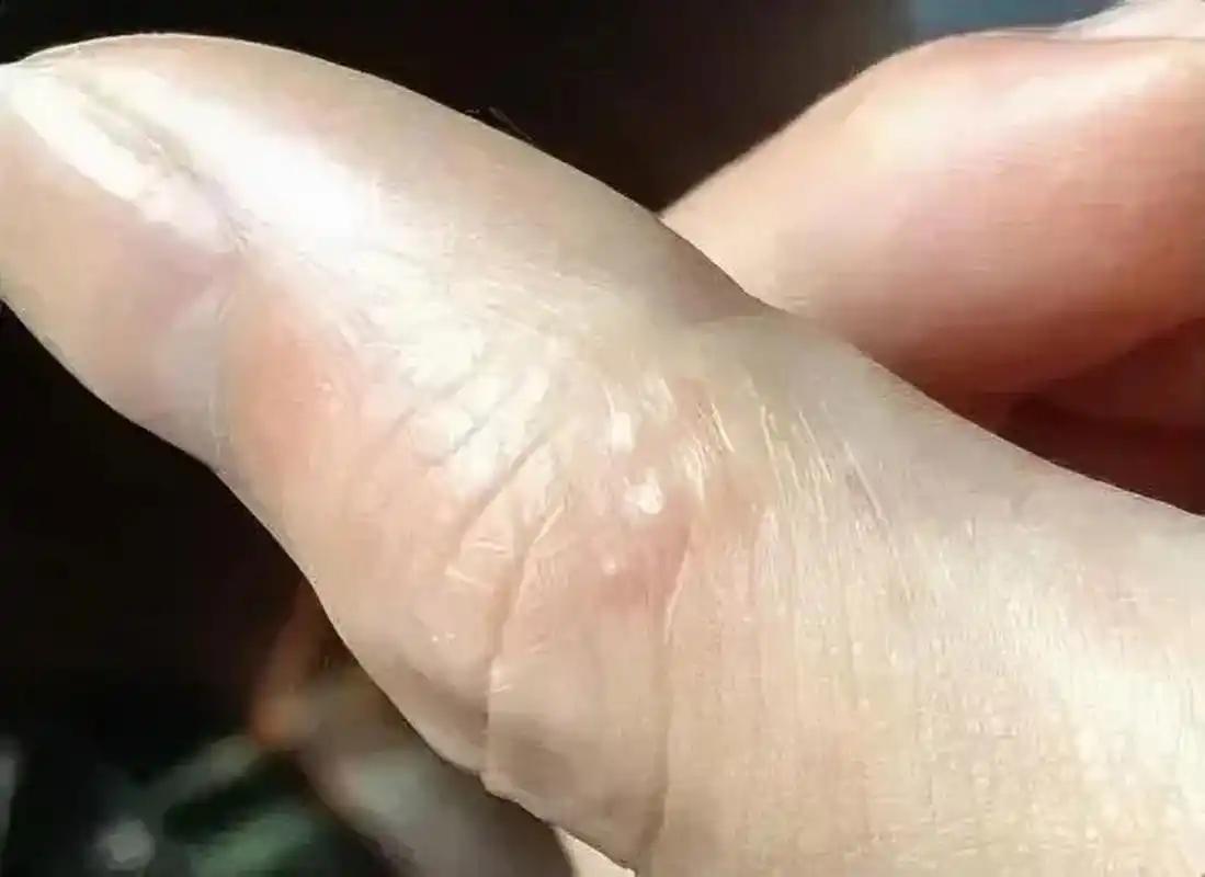 一到夏天手上就会起水泡