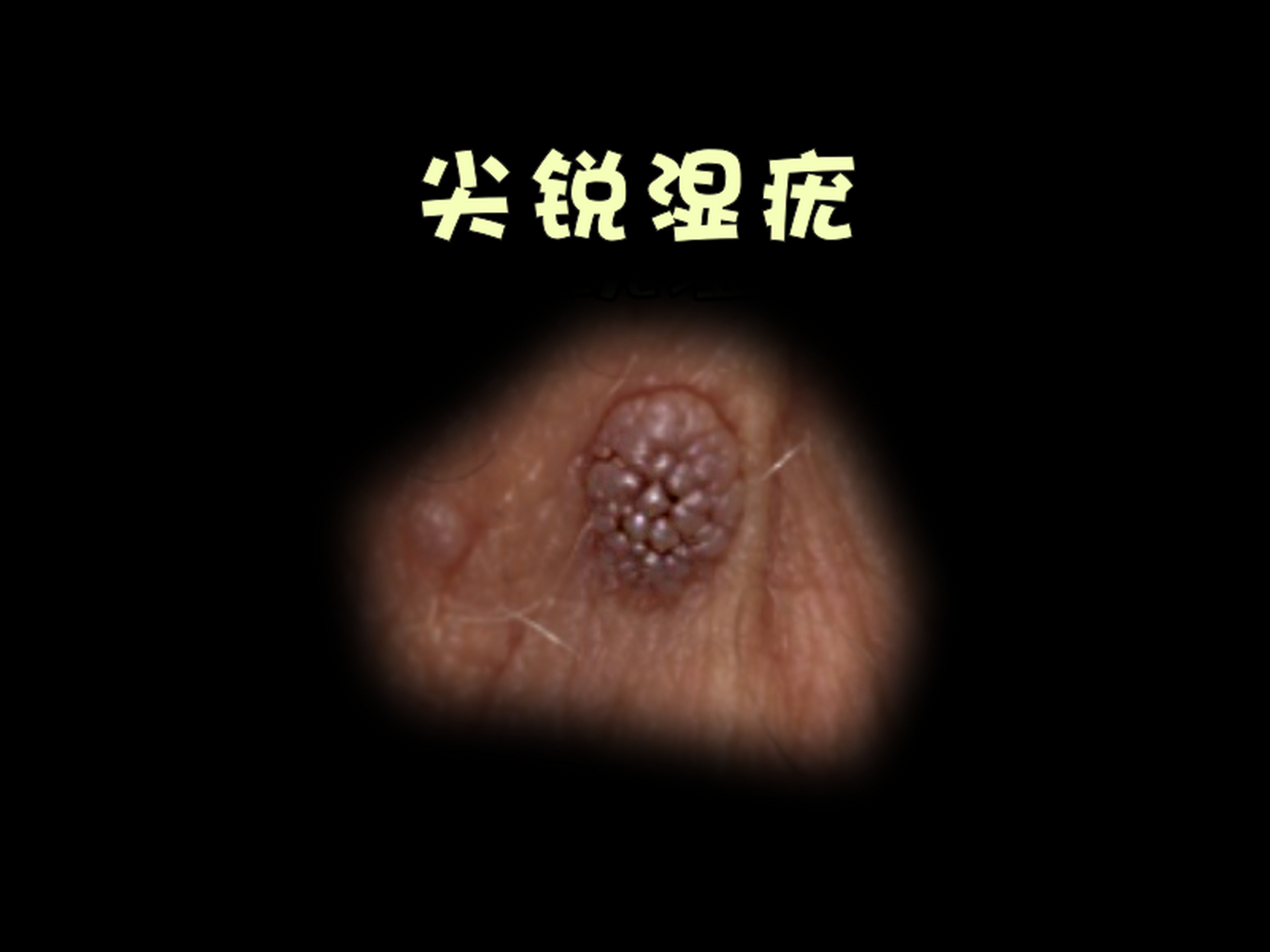 尖锐湿疣可以自愈吗