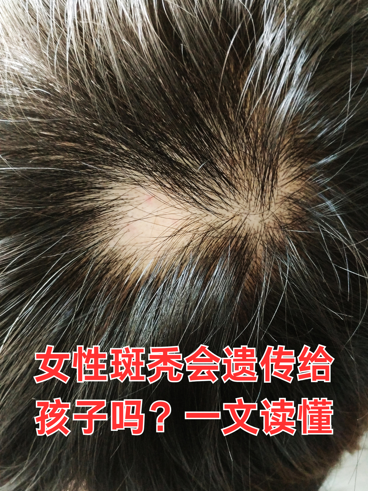 女性脱发怎么治疗