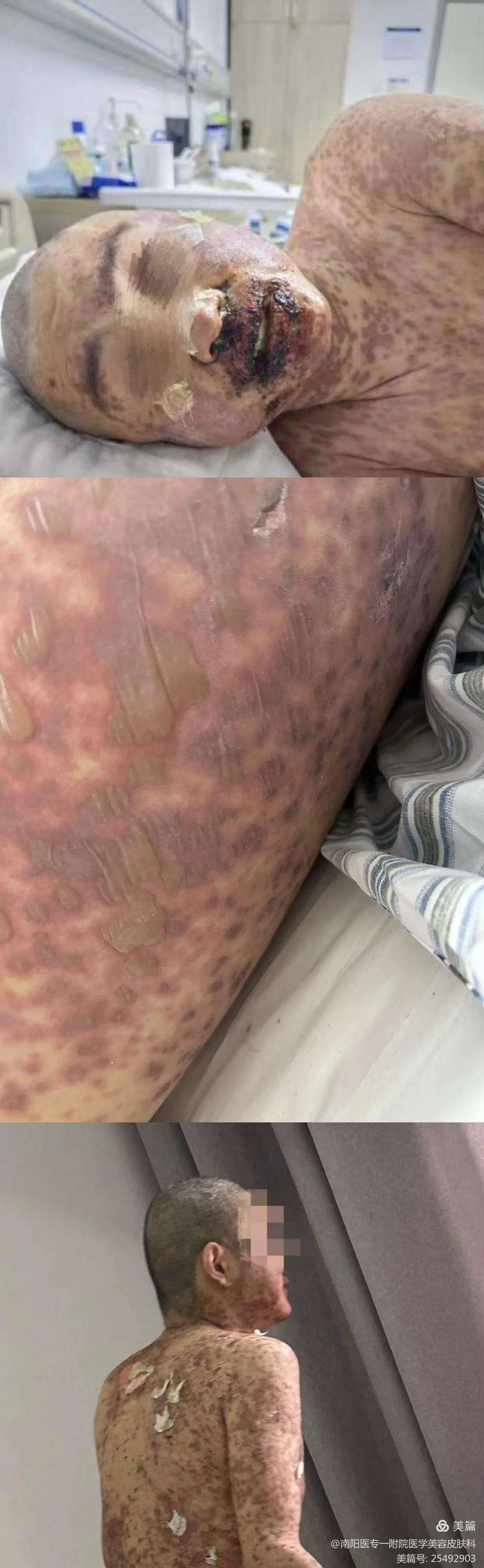 药疹一般需要如何治疗?