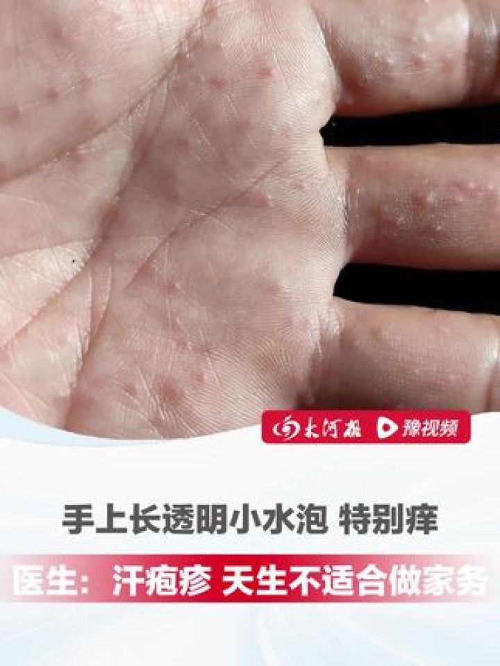 手上起小水泡是怎么回事
