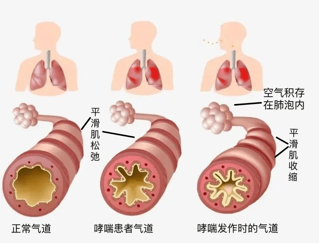 过敏性哮喘的症状有哪些?