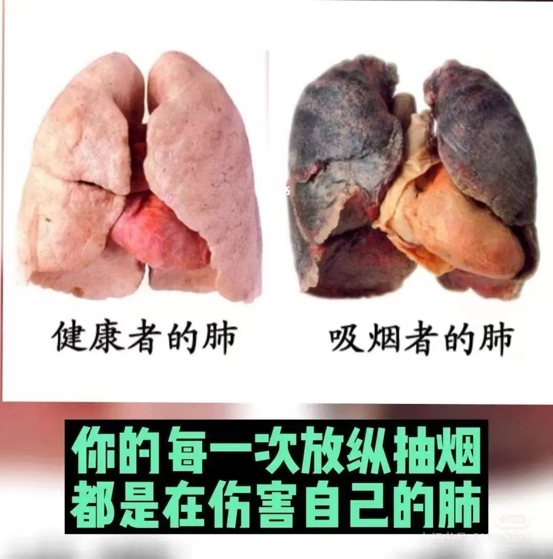 抽烟的肺是