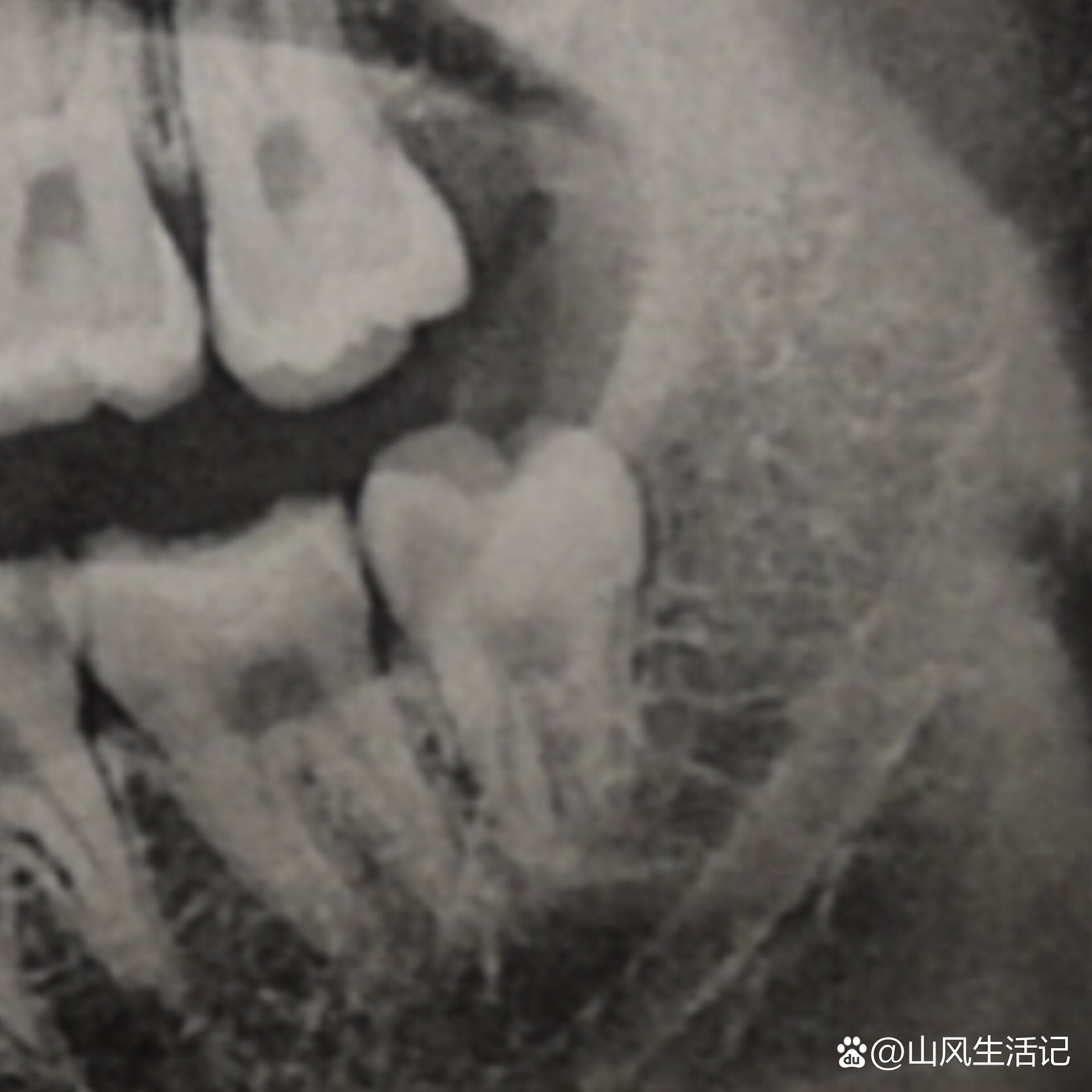 来月经最后几天能拔智齿吗?