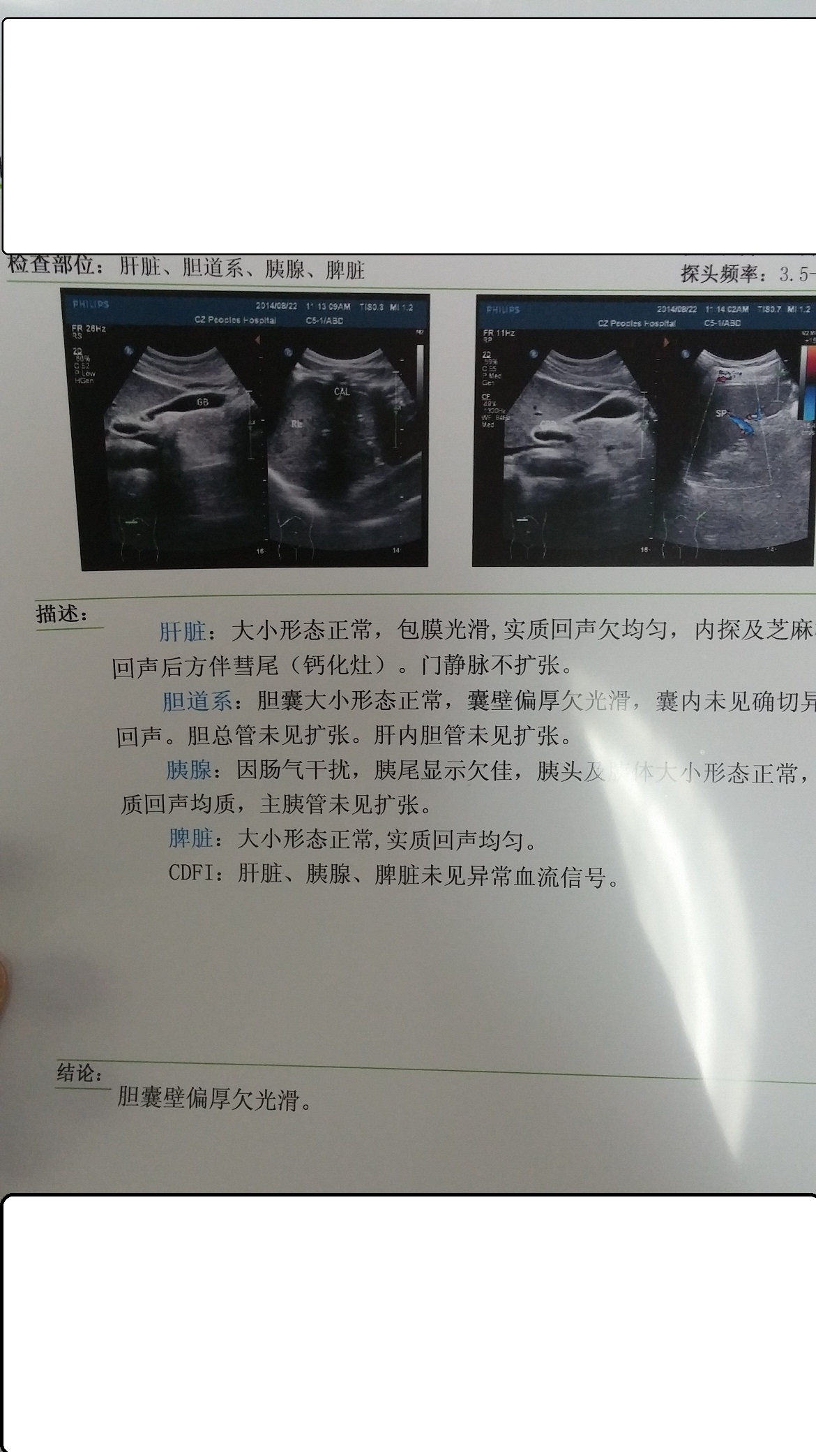 肝脏钙化灶会癌变吗
